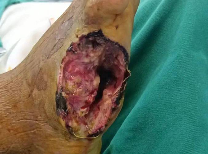 因糖尿病截肢！球爹：曾想放弃生命 是儿子们的鼓励让我坚持下来